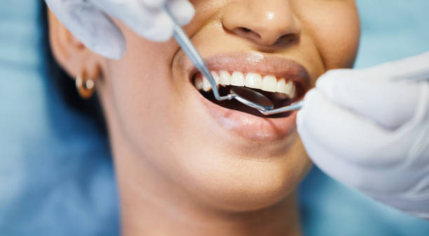 Best Emergency Wisdom Tooth Extraction in West Hurley, NY